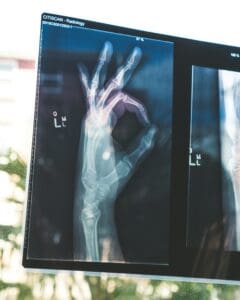 Hand X-ray radiology image highlighting bone structure and health assessment.