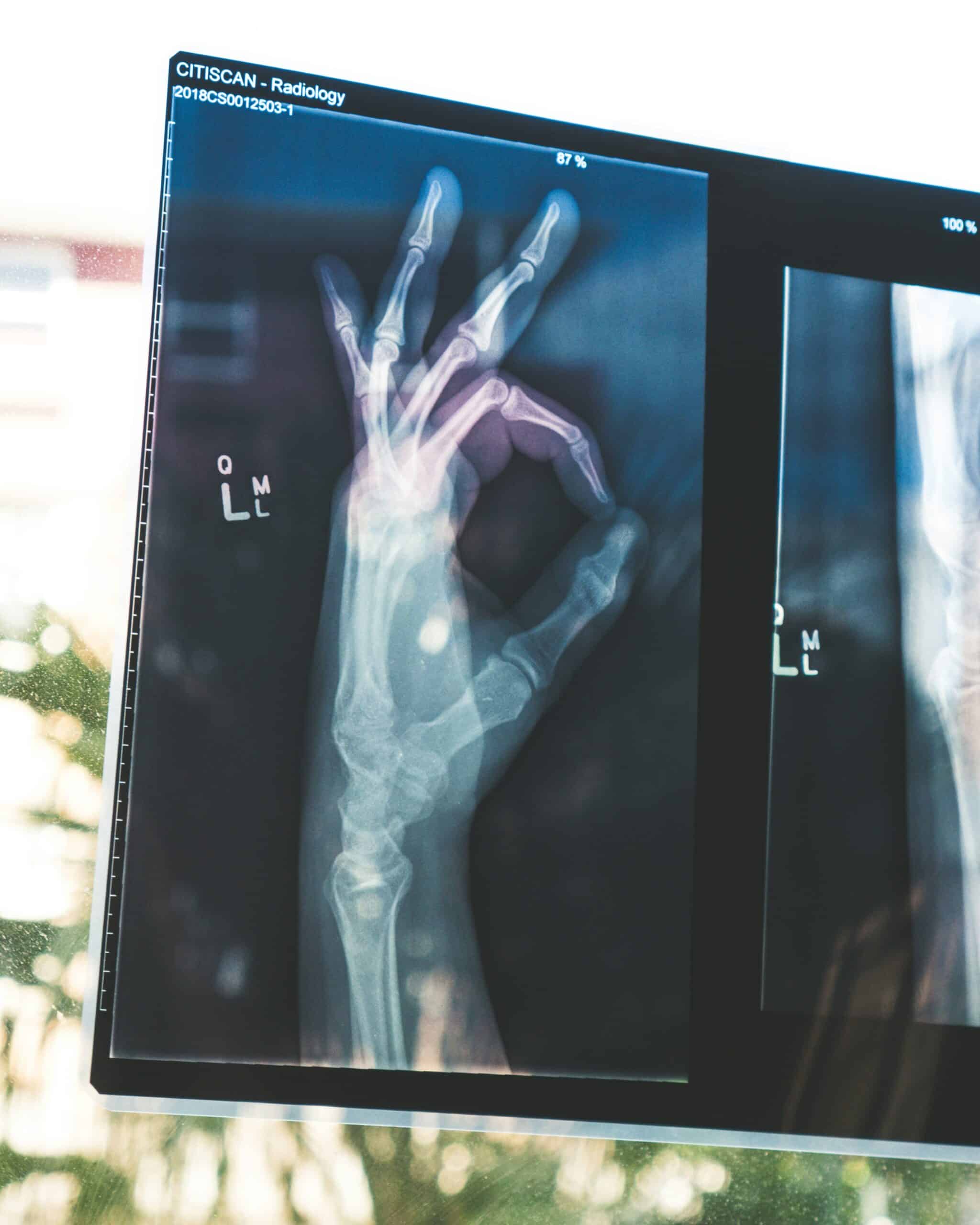 Hand X-ray radiology image highlighting bone structure and health assessment.